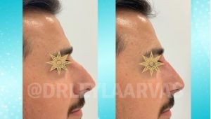 Burun Dolgusu Nedir?