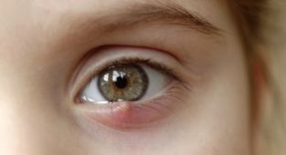 Geçmeyen Arpacık Göz Bozukluğu İşareti Olabilir!