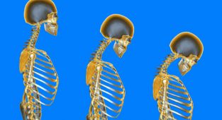 Osteoporoz En Çok Kadınlarda Görülüyor
