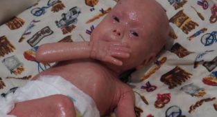 'Yılan bebek' Gökdeniz 1 yaşında