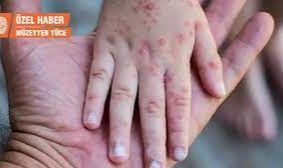 Maymun Çiçeği Hastalığı Ülkemizde İlk Kez Görüldü