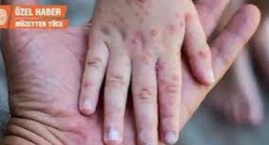 Rusya’da İlk Maymun Çiçeği Vakası